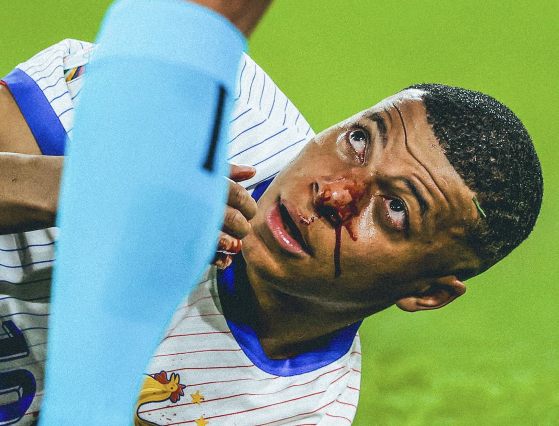 Mbappé en sang après sa blessure au nez face à l’Autriche à l’Euro 2024